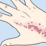 How to Get Rid of Hives Fast