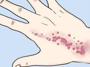 how to get rid of hives