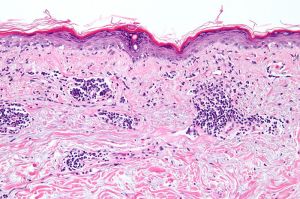eczema