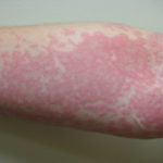 The Way to Eliminate Hives